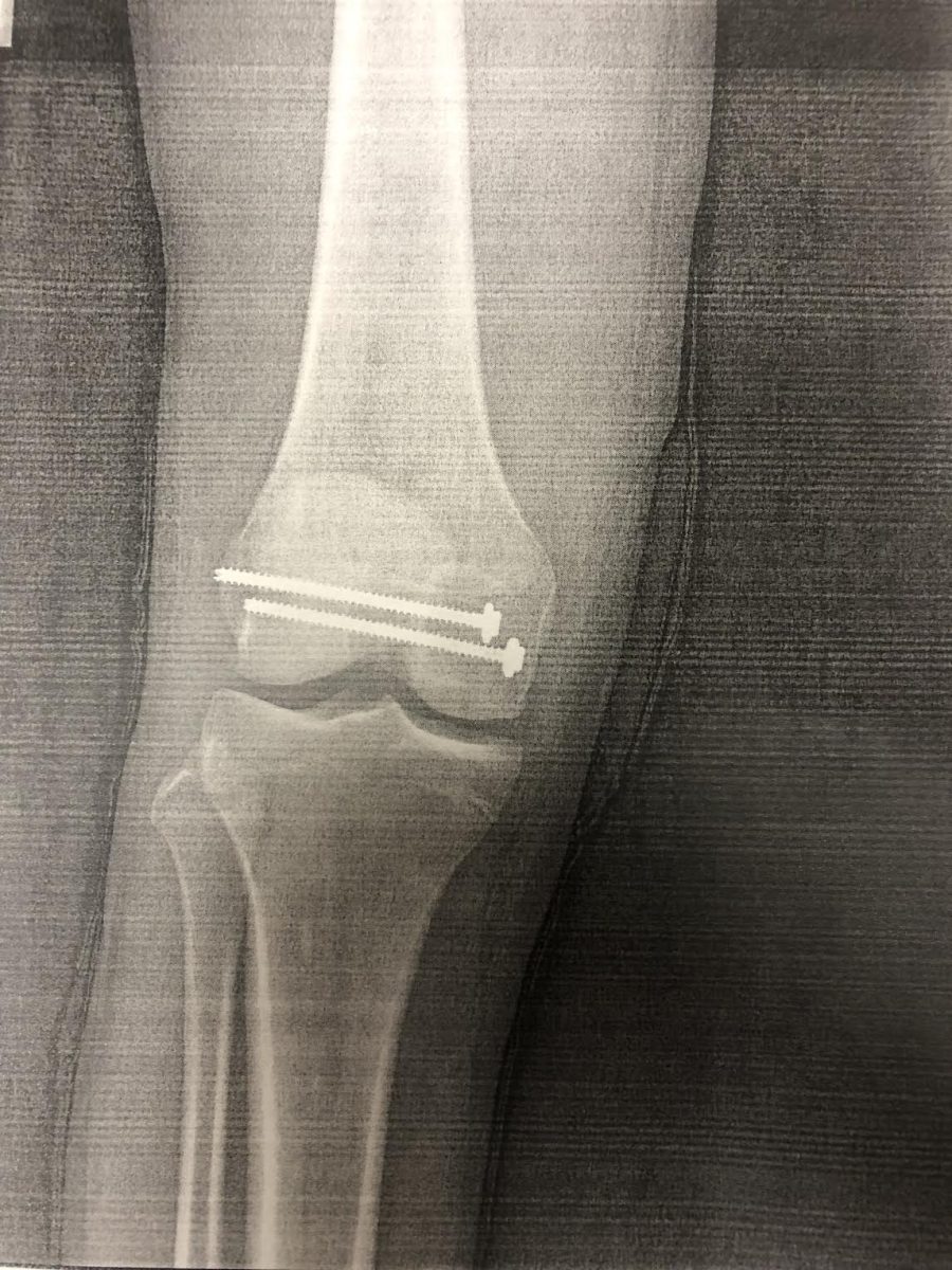 Junior James Adams xray post surgery 